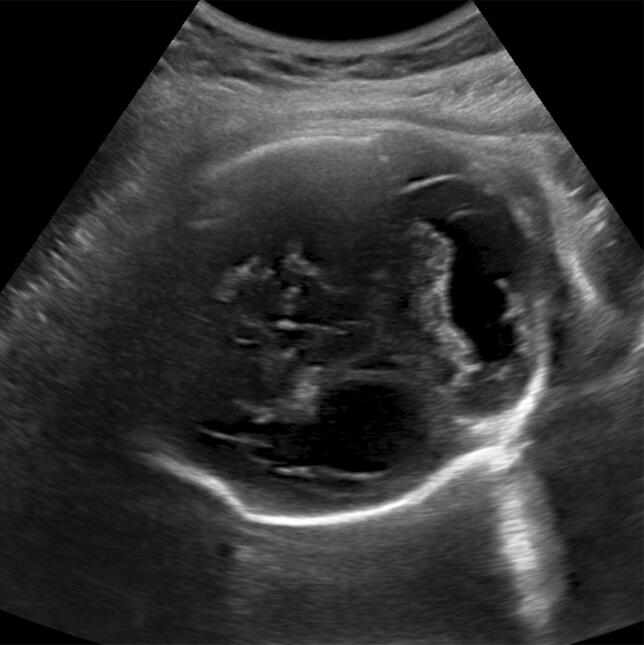 El zika y el cerebro de una bebé de una madre de 18 años 8a.jpeg