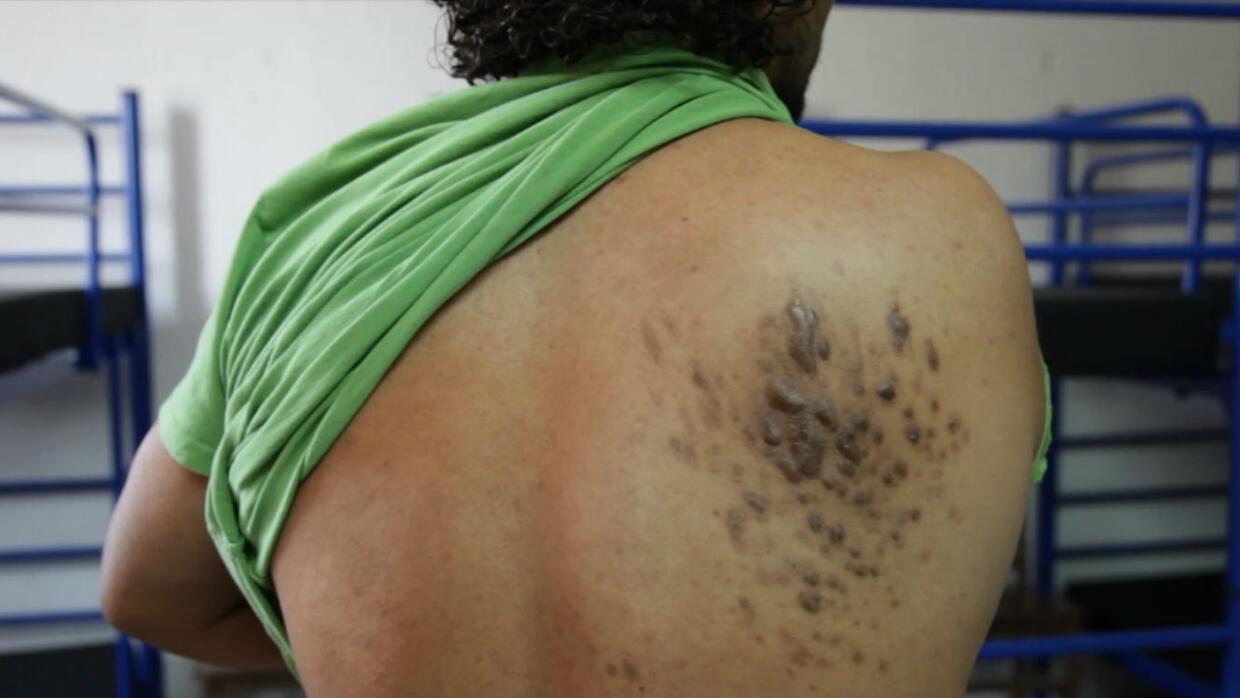 Un migrante hondureño fue herido con una escopeta. Cientos de perdigones...